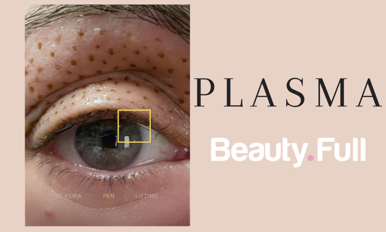 Plasma Pen Θεραπεία Αναίμακτης Βλεφαροπλαστικής