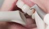Κατεχάκη: Καθαρισμός Δοντιών με Yπέρηχους-Σοδοβολή - 05